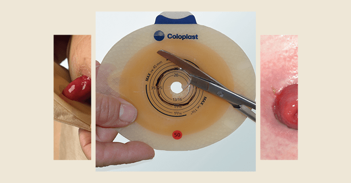 Cuidados de ostomía (colocación de bolsas decolostomía e ileostomía)