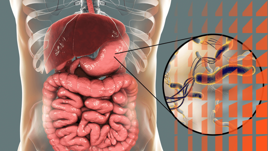 Helicobacter pylori y enfermedad ulcerosa péptica