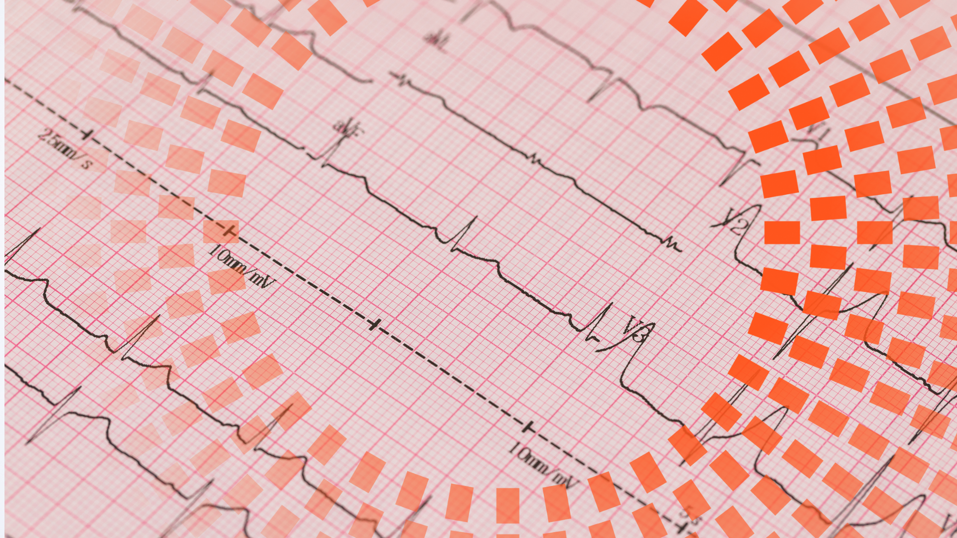 5 claves para interpretar el electrocardiograma de forma clara