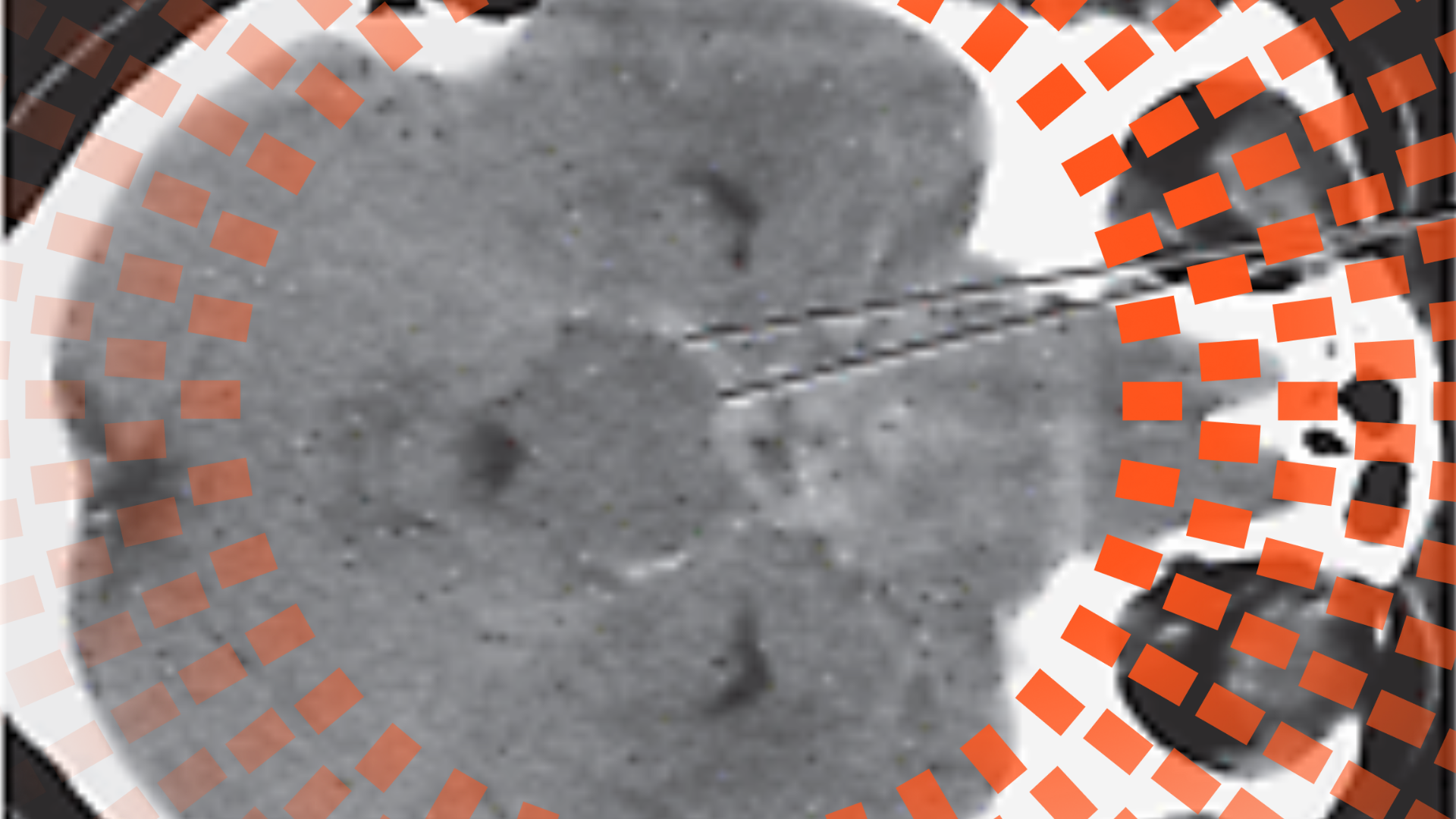 Pensamiento clínico: precaución en hemorragia subaracnoidea