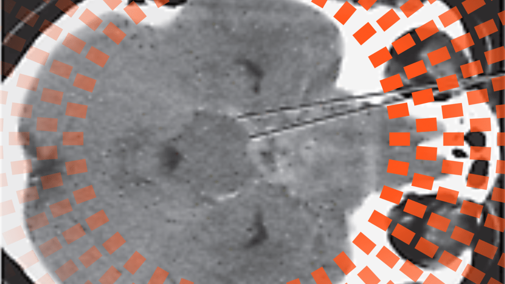 Pensamiento clínico: precaución en hemorragia subaracnoidea